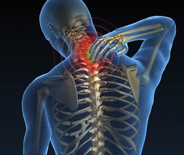 Osteocondrose cervical