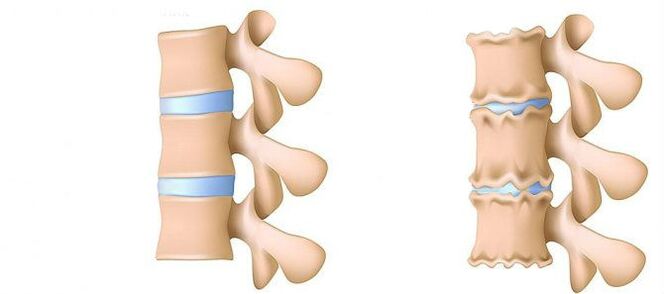 Osteocondrose da rexión lumbar
