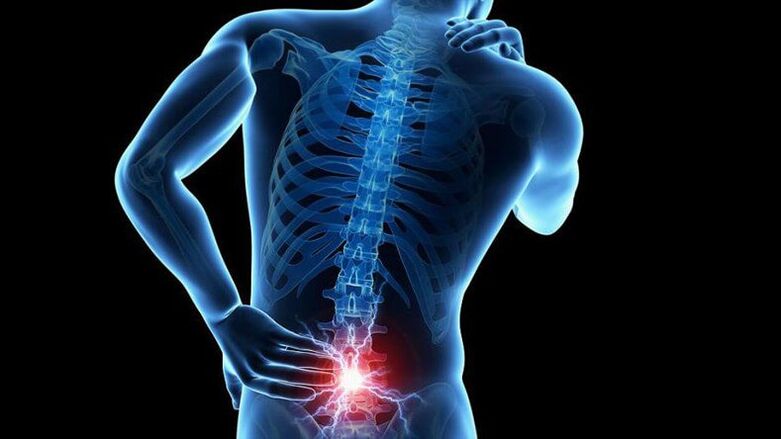 Síntomas da osteocondrose lumbar